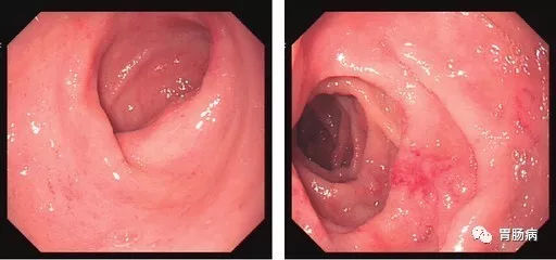 萎縮性胃炎不可怕，只要真正了解它