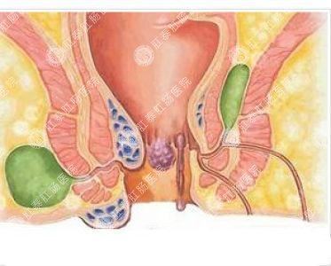 南寧哪個(gè)醫(yī)院可以做肛周膿腫？